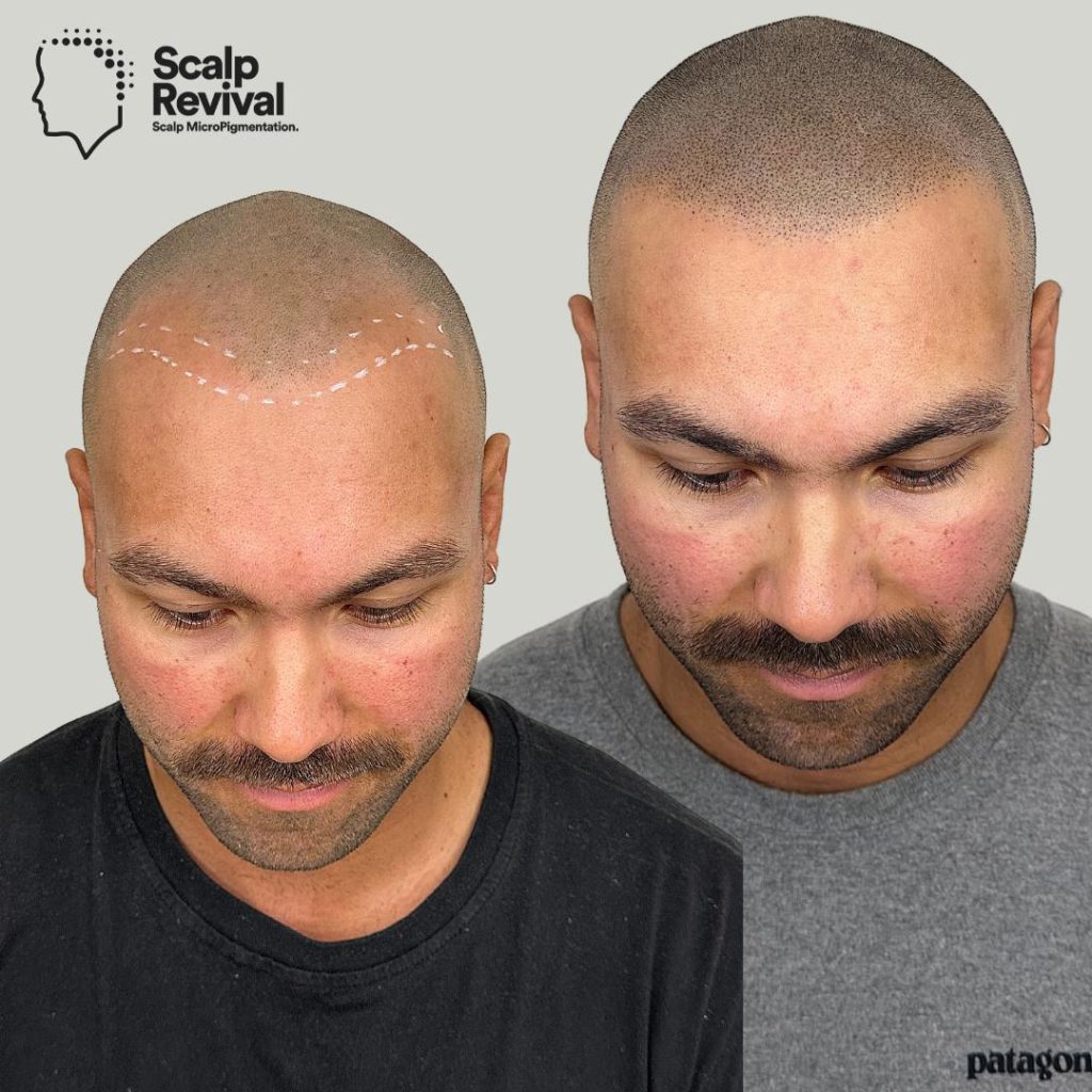 What Is Scalp Micropigmentation And How Can It Help You Overcome Hair –  Zensa Skin Care